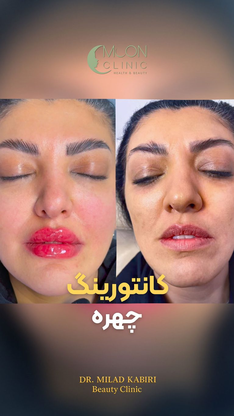 فیلر-لب-10